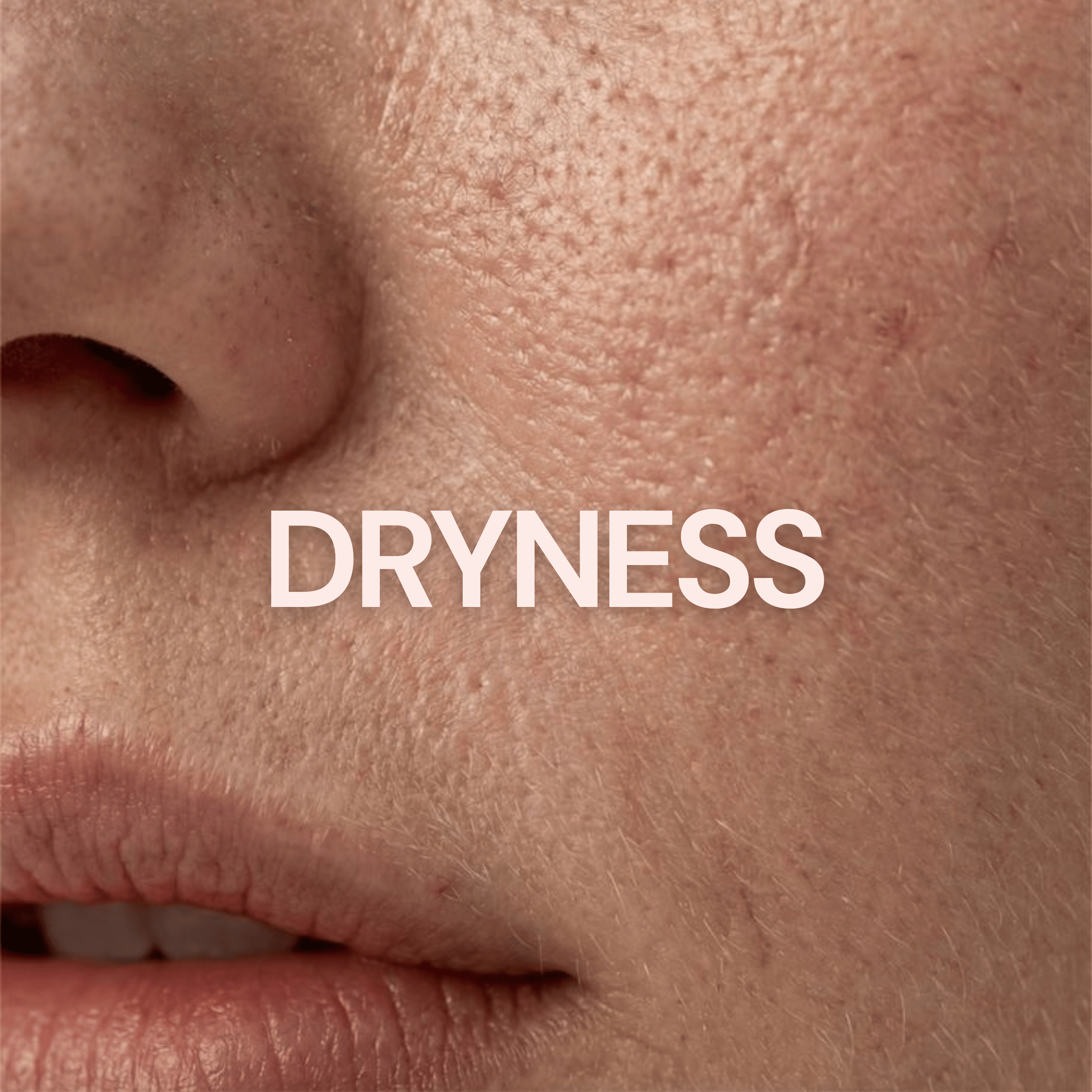 Buy Dry Skin Care | Ceramide Moisturizer Online - Root Labs